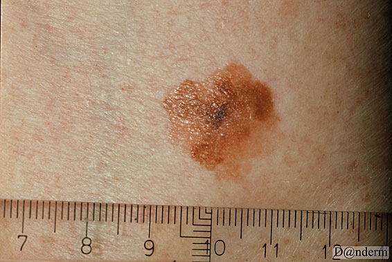 7-159-11_Malignant_melanoma_superficial_spreading