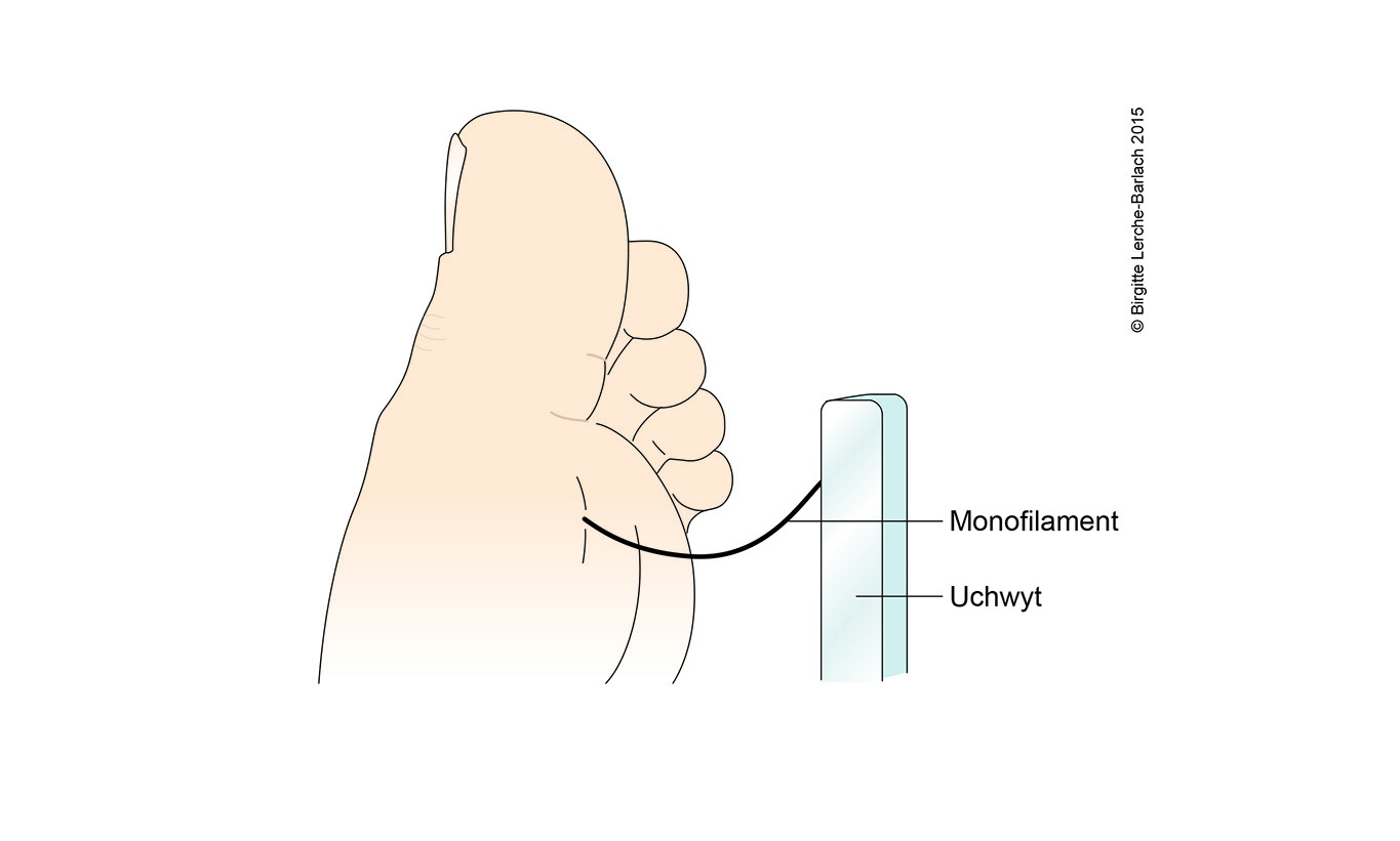 Neuropatia cukrzycowa - Monofilament Ilustracja monofilament