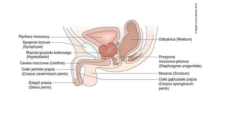 Ilustracja gruczoł krokowy powiększony (hipertrofia).jpg