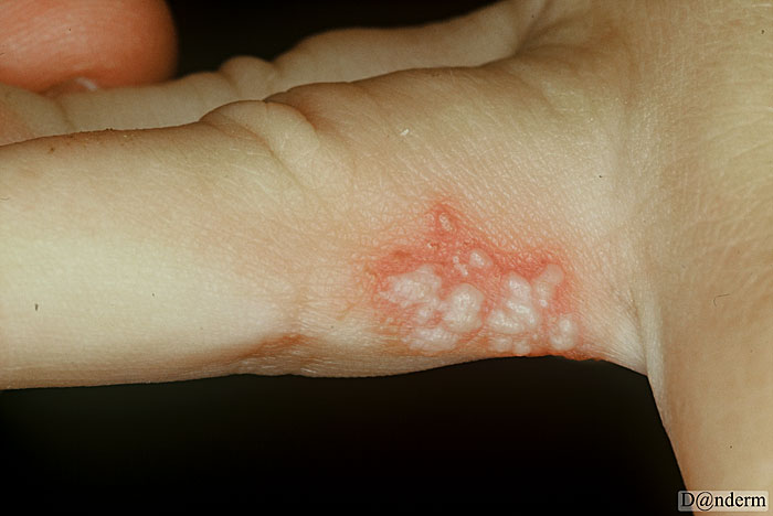 8-81-2_Herpes_zosterin_a_child