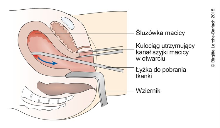 Łyżeczkowanie jamy macicy Łyżeczkowanie jamy macicy schemat