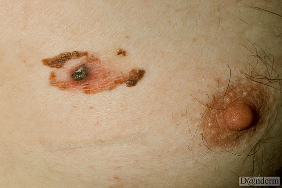 7-167-8_Malignant_melanoma_nodular