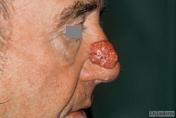 7-91-10_Basal_cell_carcinoma_-_nodular_(1_of_2)