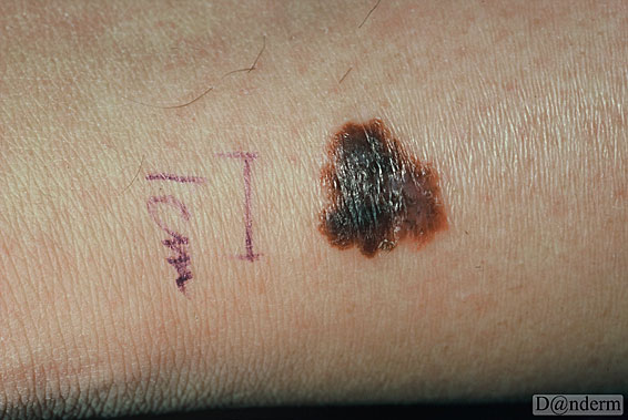 7-159-9_Malignant_melanoma_superficial_spreading