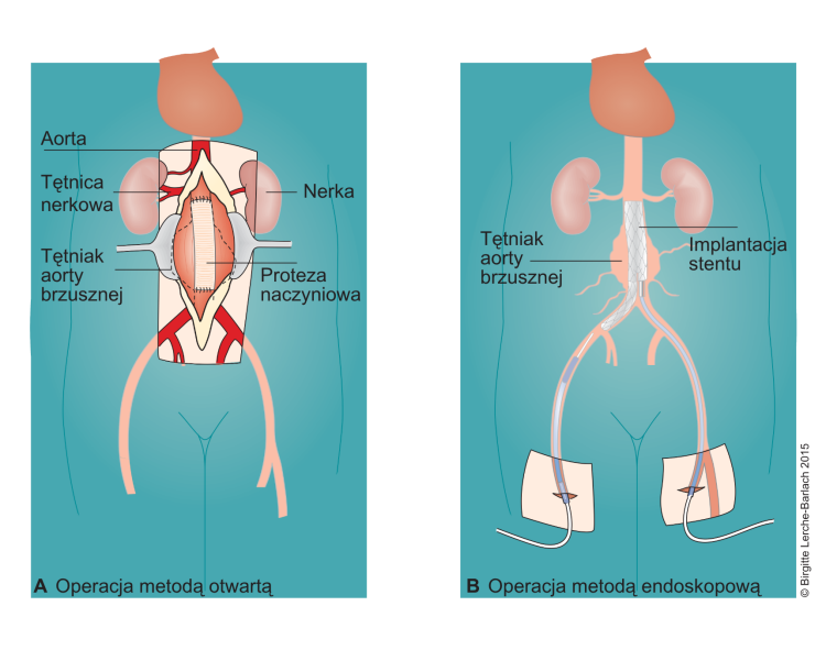 Tętniak aorty brzusznej ilustracja dwóch metod operacyjnych przy tętniaku aorty brzusznej, metoda otwarta, wprowadzanie stentu