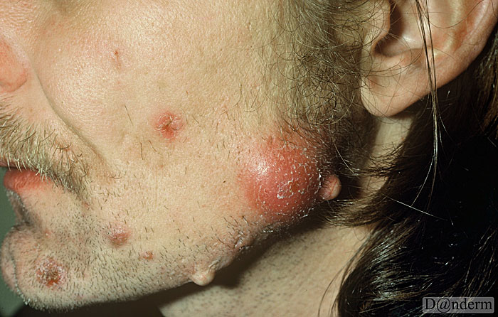 4-105-7_Cystic_acne