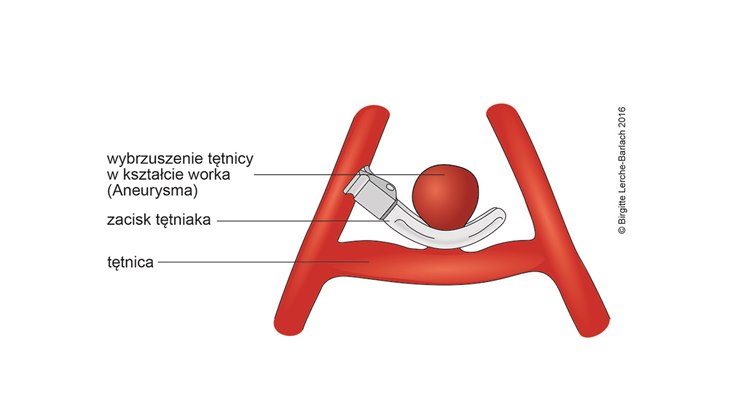 Ilustracja usuwanie tętniaka