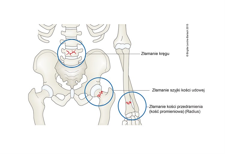 Osteoporoza Ilustracja najczęstsze miejsca złamań w przebiegu osteoporozy