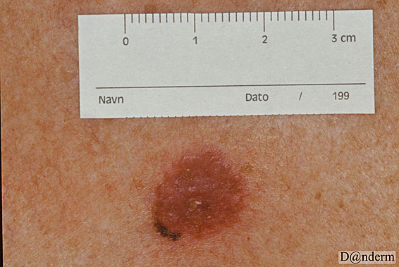 7-159-10_Malignant_melanoma_superficial_spreading