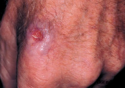 7-121_Squamous_cell_carcinoma_on_the_hand