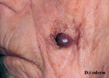 7-157_Lentigo_maligna_melanoma