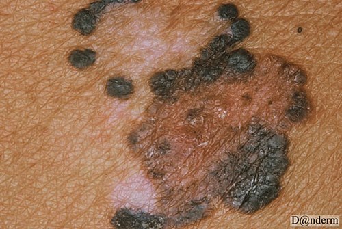 7-178-1_Malignant_melanoma_with_regression