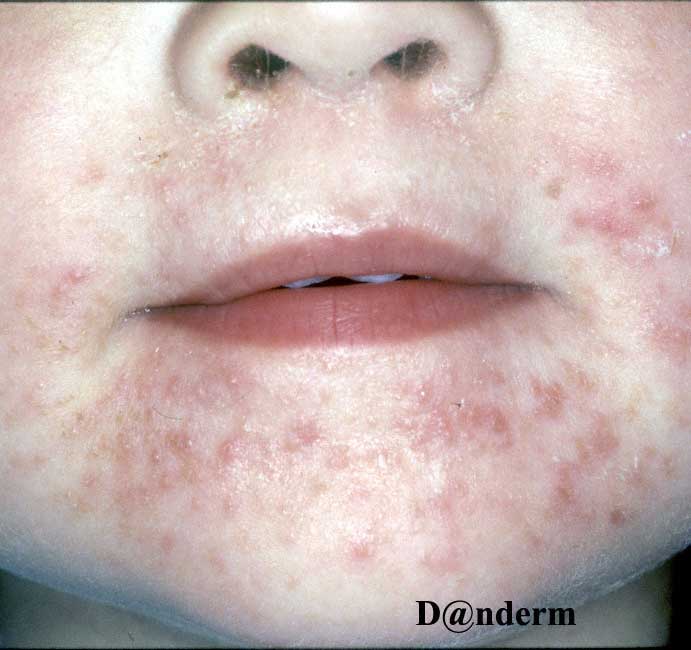 4-150-1_Periorificial_dermatitis_in_a_2-year-old