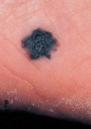 7-165_Malignant_melanoma_(2_of_2)