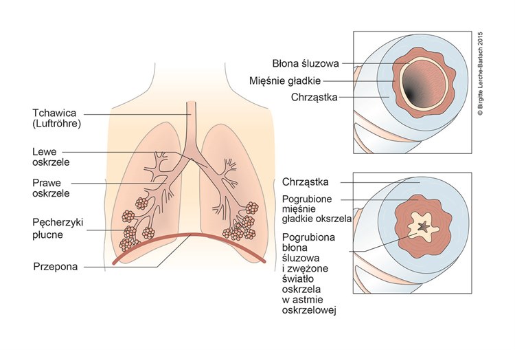 Napad astmatyczny u dzieci i młodzieży Ilustracja drogi oddechowe i zmiany w astmie oskrzelowej