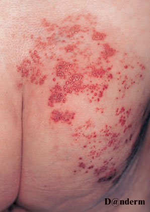 8-82_Herpes_zoster_(1_of_2)