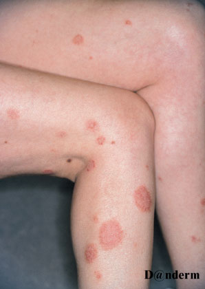2-122_Nummular_eczema_of_the_legs_(1_of_2)