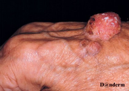 7-122_Squamous_cell_carcinoma_on_the_hand