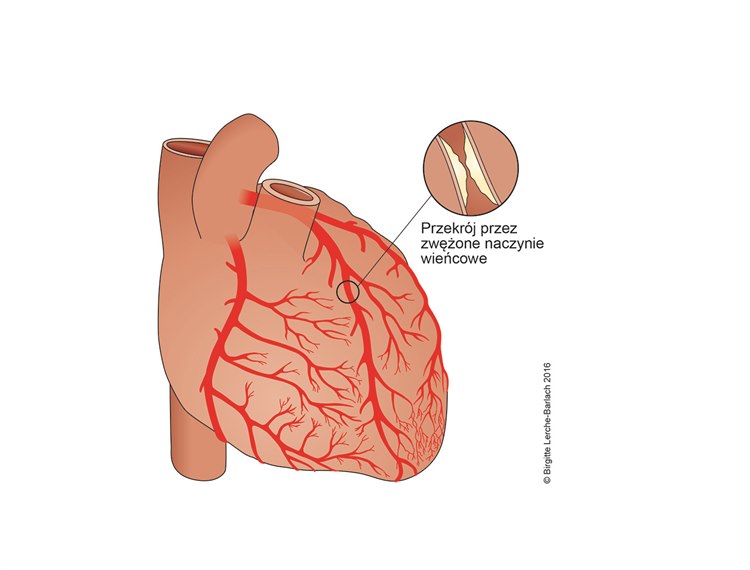  Ilustracja zwężone naczynie wieńcowe