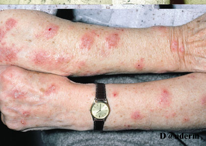 2-124_Nummular_eczema_of_the_arms