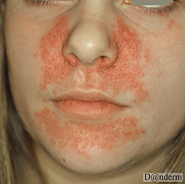 4-146-3_Periorificial_dermatitis
