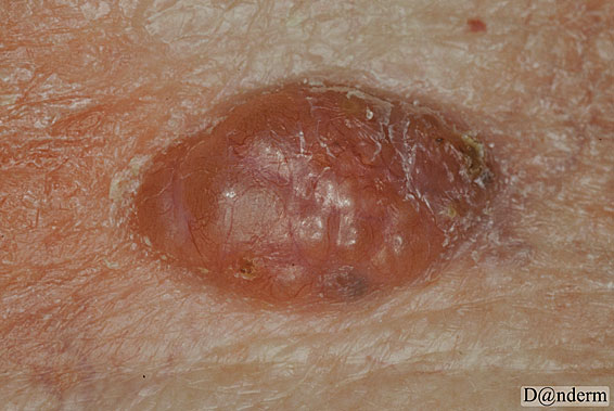 7-91-4_Basal_cell_carcinoma_-_nodular