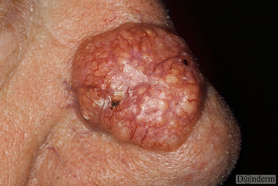 7-91-11_Basal_cell_carcinoma_-_nodular_(2_of_2)