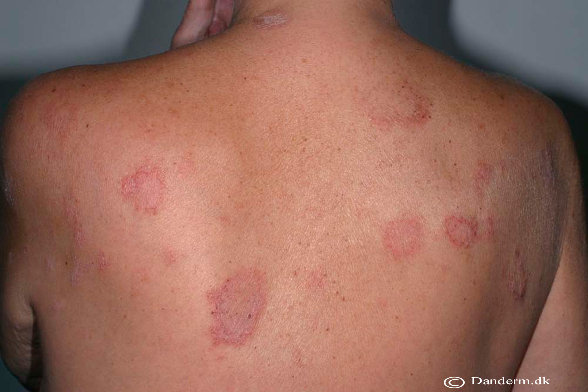 2-123-1_Nummular_eczema_of_the_back_1_of_2