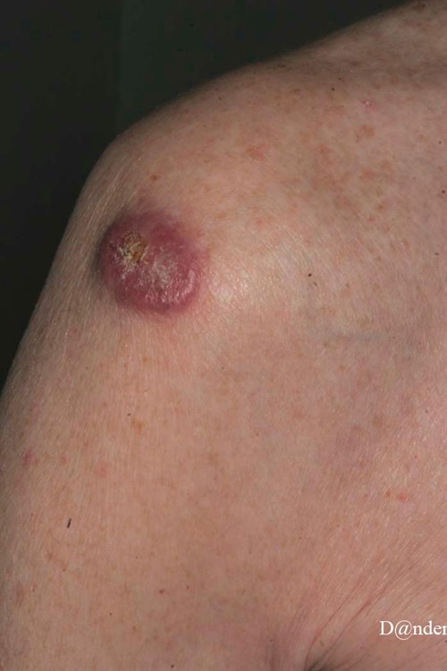 7-122-1_Squamous-cell-carcinoma_1-of-2