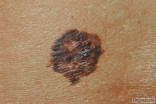 7-159-8_Malignant_melanoma_superficial_spreading