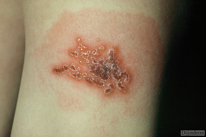8-81-4_Herpes_zoster_in_a_child