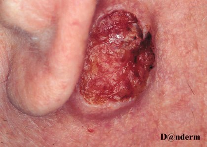 7-119_Squamous_cell_carcinoma_-_retroauricular