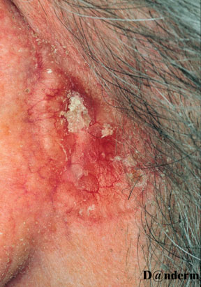 7-93_Basal_cell_carcinoma_behind_the_ear
