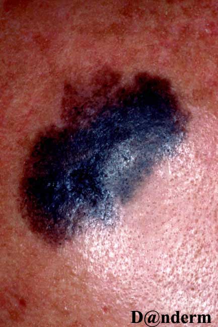 7-159-2_Malignant_melanoma,_superficial_spreading_(2_of_2)