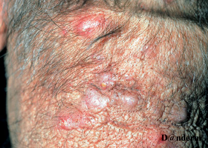 4-128_Keloidal_acne
