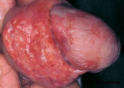 7-123_Squamous_cell_carcinoma_on_the_penis