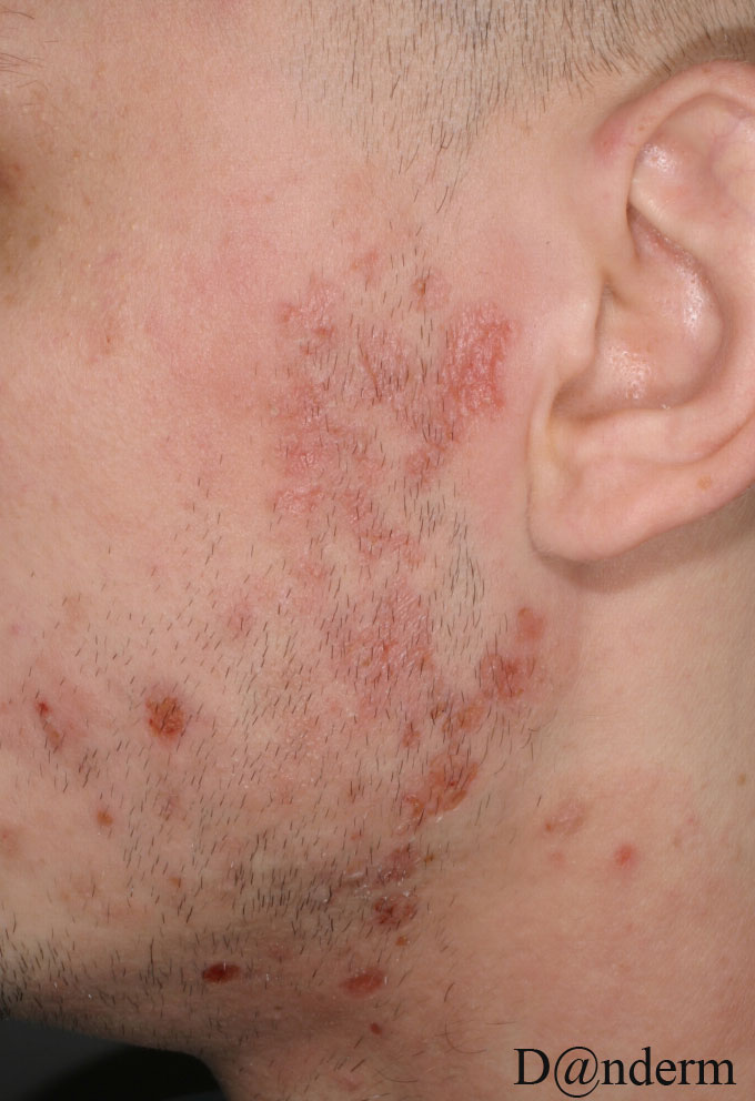 2-108-9_Atopic_dermatitis