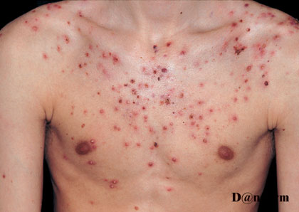 4-112_Acne_fulminans_(2_of_5)