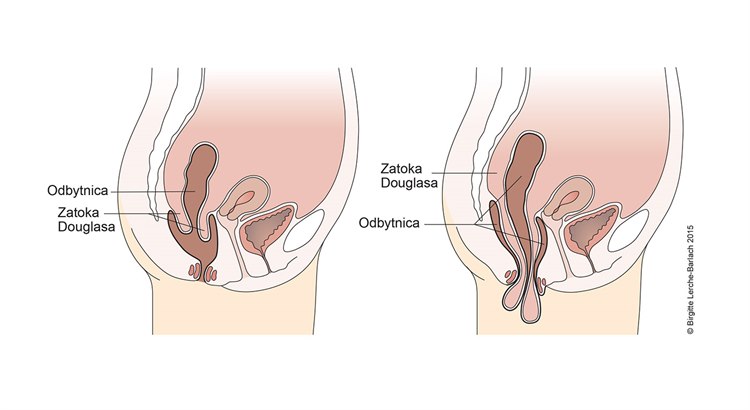Dyskomfort w odbycie/ odbytnicy - ilustr. wypadanie odbytnicy.jpg