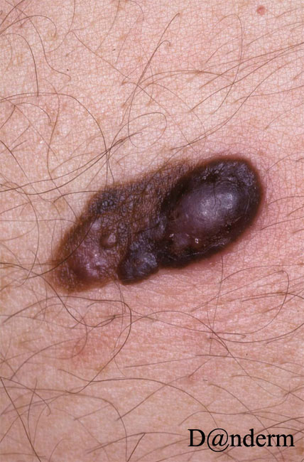 7-167-2_Malignant_melanoma,_nodular_(2_of_2)