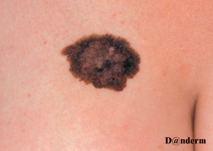 7-160_Malignant_melanoma_(1_of_2)