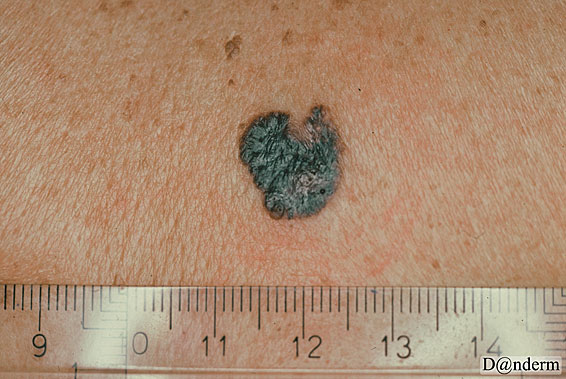 7-159-6_Malignant_melanoma_superficial_spreading_and_basal_cell_carcinoma_and_seborrhoeic_keratosis_(2_of_2)