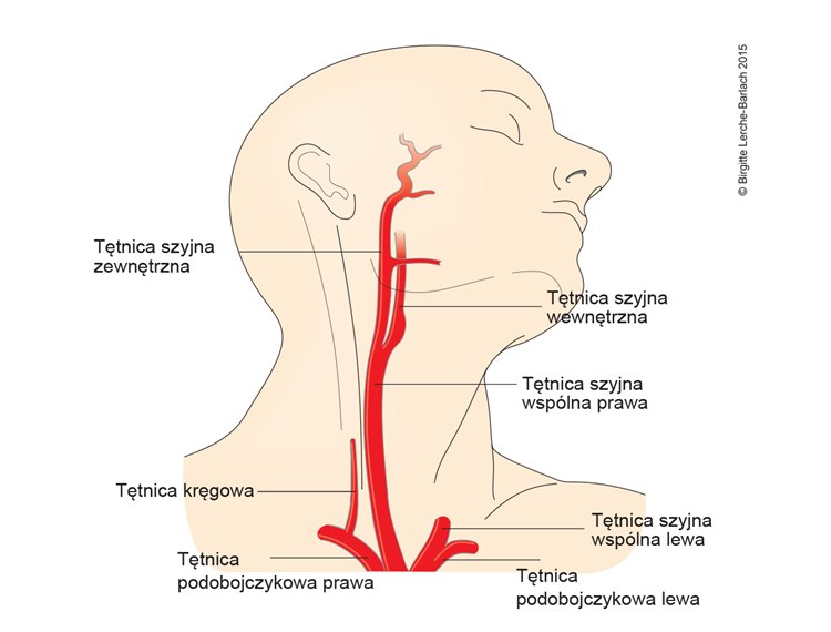 Zwężenia tętnic szyjnych, pozaczaszkowe Ilustracja tętnice szyjne