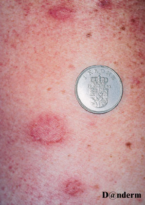 2-126_Nummular_eczema_of_the_arms_(2_of_2)