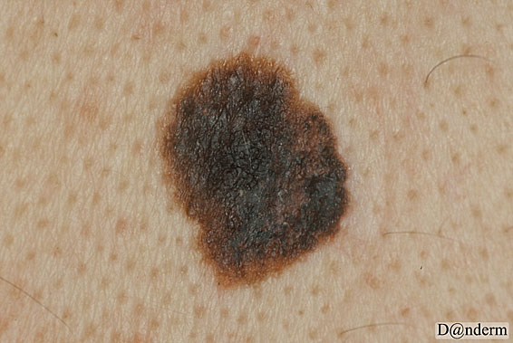 7-159-4_Malignant_melanoma_superficial_spreading_and_basal_cell_carcinoma_(2_of_2)