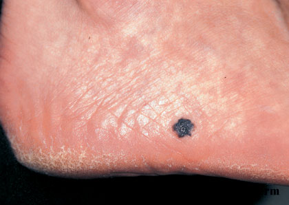 7-164_Malignant_melanoma_(1_of_2)