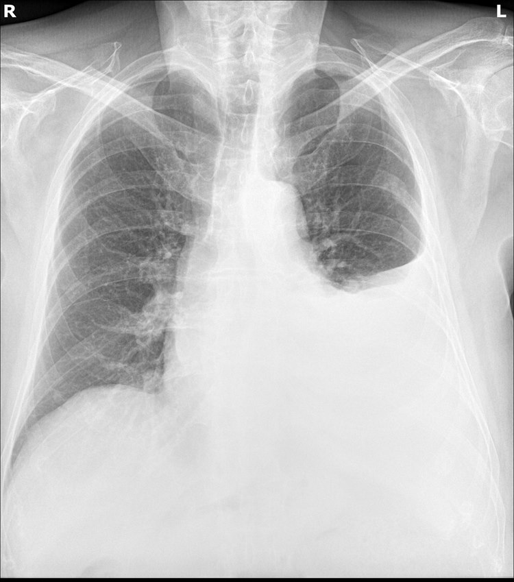 zdjęcie RTG płuca kręgosłup szkielet żebra