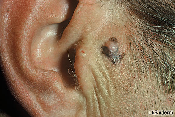 7-168-1_Malignant_melanoma_-_nodular