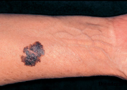 7-162_Malignant_melanoma_(1_of_2)