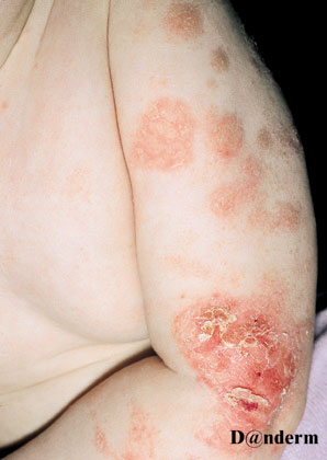 2-104_Atopic_dermatitis_of_the_upper_and_lower_arm